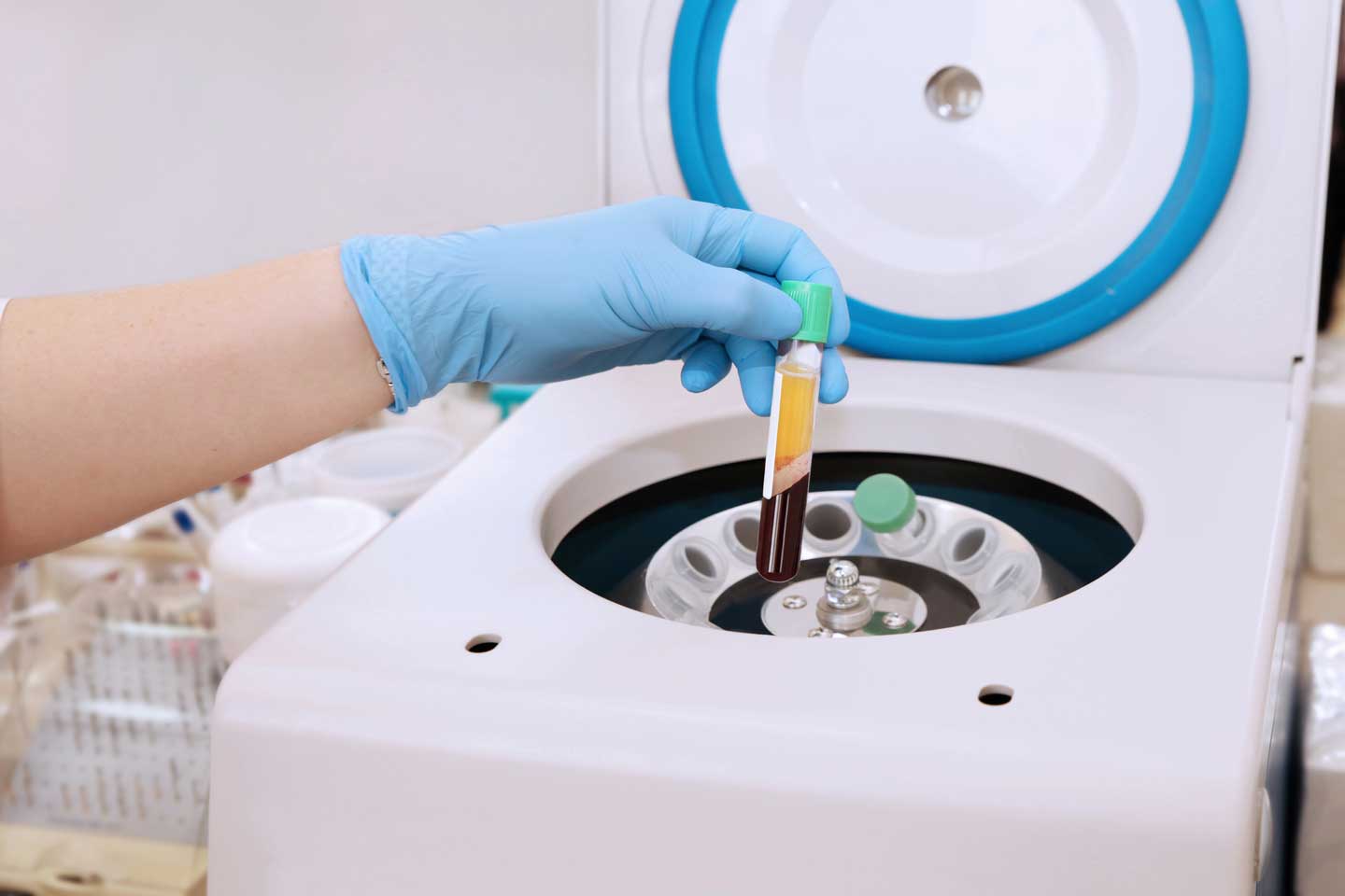 PRP-Therapie in der Orthopädie em Veedel in Köln